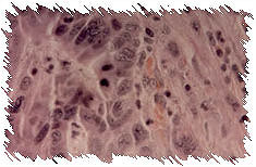 มะเร็งลำไส้ใหญ่