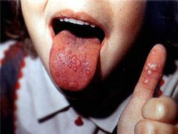 โรคมือเท้าปาก โรคของเด็กที่ผู้ใหญ่ต้องเฝ้าระวัง