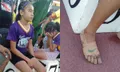 สุดยอด! เด็กหญิงยากจน ใช้ผ้าก๊อซพันเท้า วิ่งแข่งกรีฑา ชนะเหรียญทอง 3 รายการ