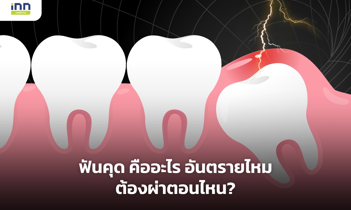 ฟันคุด คืออะไร อันตรายไหม ต้องผ่าตอนไหน?