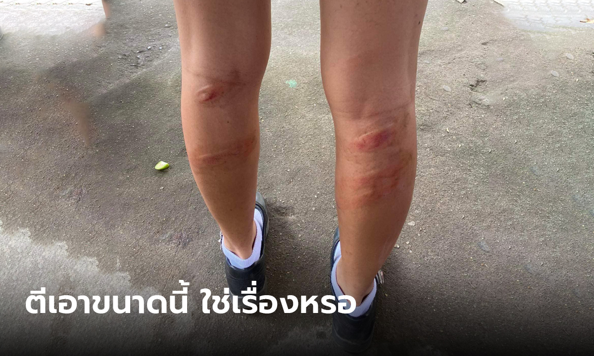 ผู้ปกครองเดือด นักเรียนถูกครูทำโทษเป็นแผลฉกรรจ์ ต้องทำถึงขนาดนี้เลยหรอ?