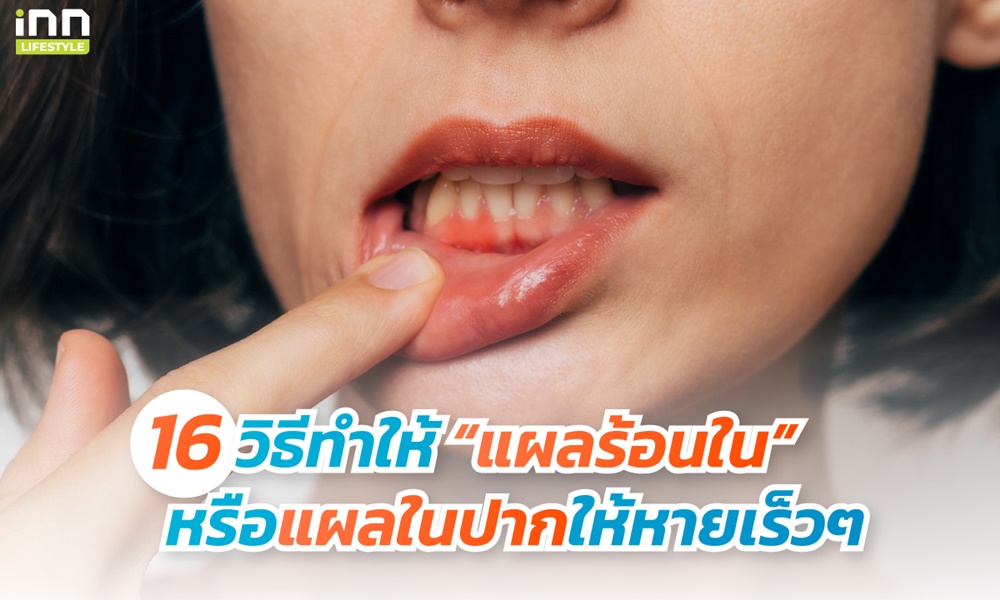 แผลร้อนใน กับ 15 วิธีแก้แผลร้อนในให้หายเร็วๆ