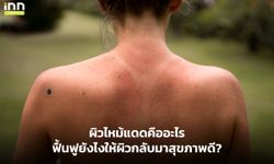 ผิวไหม้แดดคืออะไร ฟื้นฟูยังไงให้ผิวกลับมาสุขภาพดี?