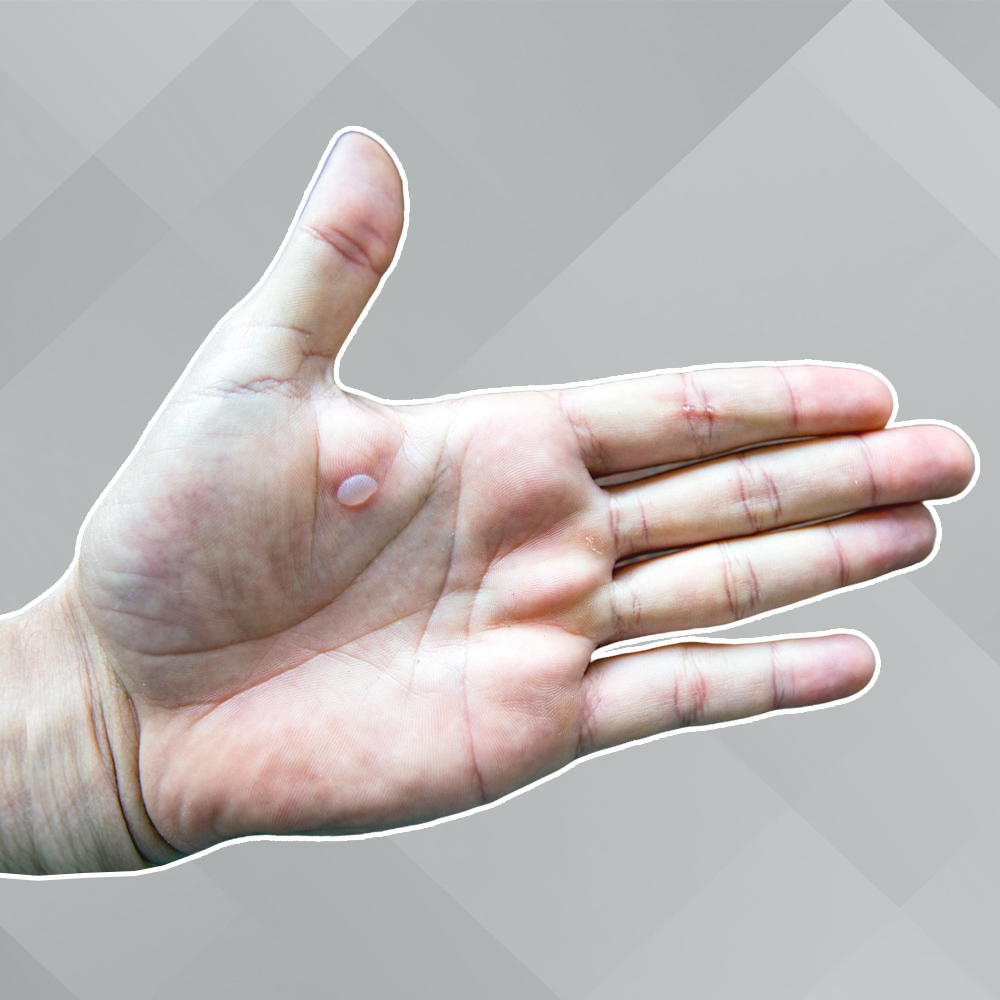 ตุ่มพองใส ควรเจาะไหม