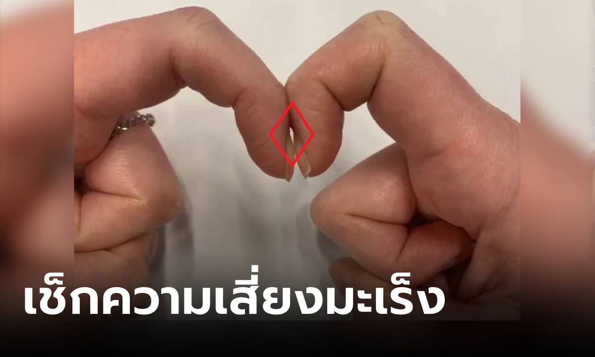 แค่ทำมือตามนี้! ทดสอบความเสี่ยง "มะเร็ง" ใช้เวลาแค่ 5 วินาที ผู้เชี่ยวชาญแนะนำเอง