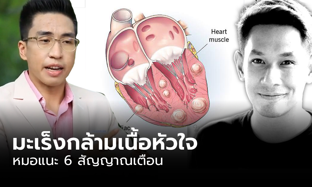 ภาพหมอแนะ 6 สัญญาณเตือน "มะเร็งกล้ามเนื้อหัวใจ" ภัยร้ายคร่าชีวิต "อ๋อม อรรคพันธ์"