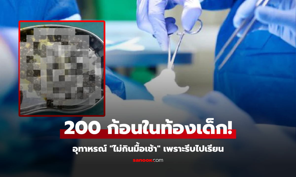 ลูกสาว 10 ขวบ "ไม่กินมื้อเช้า" พ่อแม่ช็อก ผ่าสิ่งนี้จากท้อง 200 ก้อน แพทย์ยังตกใจทั้งทีม!