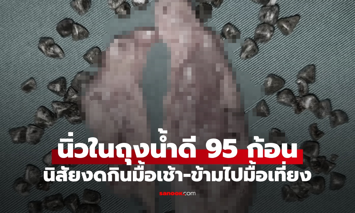 นาฬิกาชีวิตพัง หญิงมีนิ่วในถุงน้ำดี 95 ก้อน งดมื้อเช้า-ข้ามไปมื้อเที่ยง อันตรายกว่าที่คิด