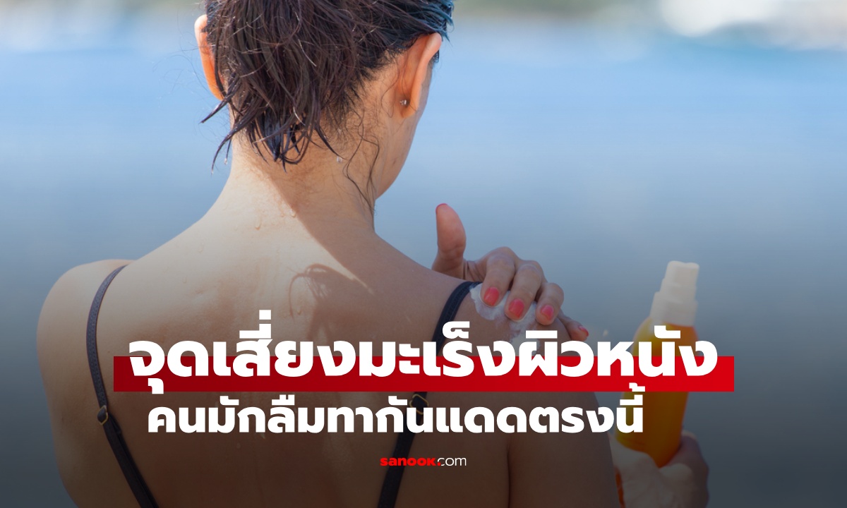 แพทย์ชี้ "จุดนี้" บนร่างกาย เสี่ยงมะเร็งผิวหนังมากที่สุด ตำแหน่งที่คนมักลืมทาครีมกันแดด