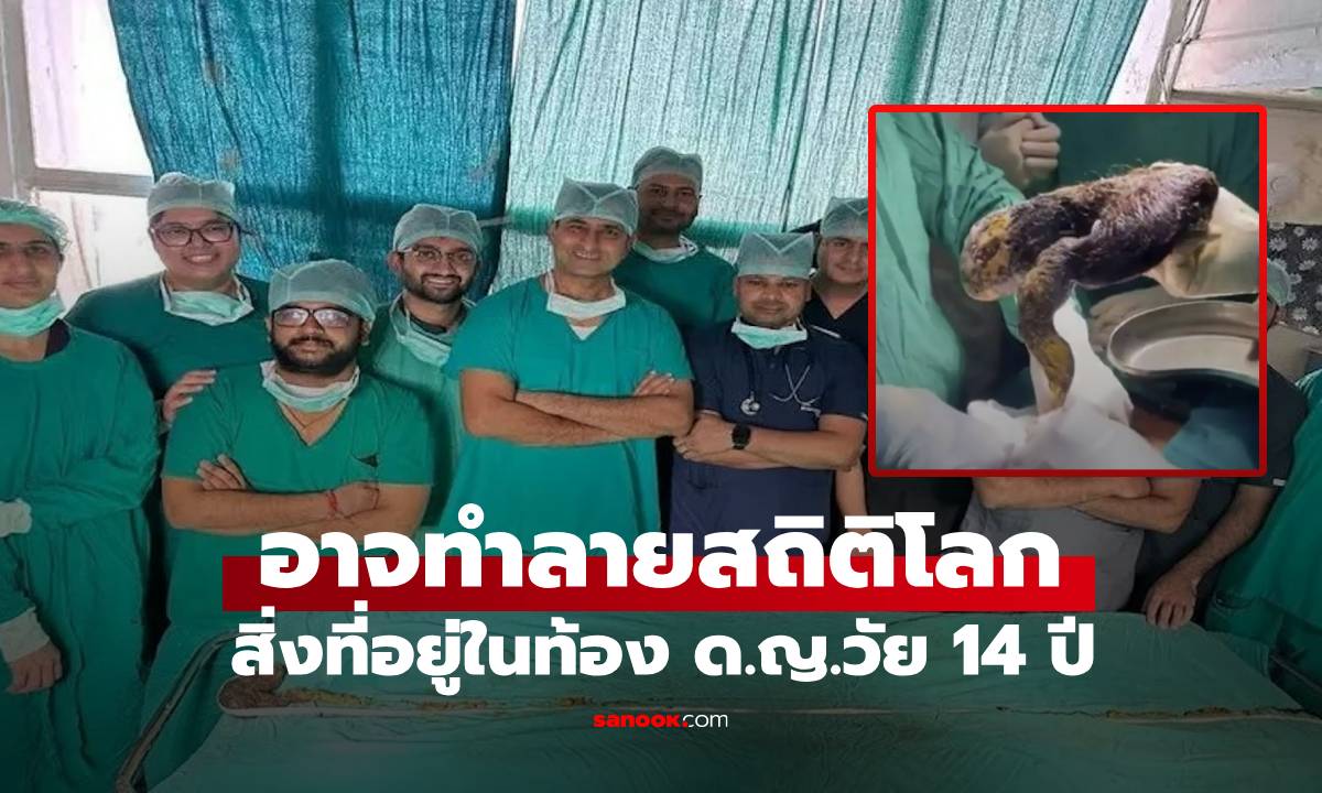 ด.ญ.วัย 14 ปวดท้อง-อาเจียนหนัก! หมอช็อกสิ่งที่พบหลังผ่าท้อง อาจสร้างสถิติโลกใหม่