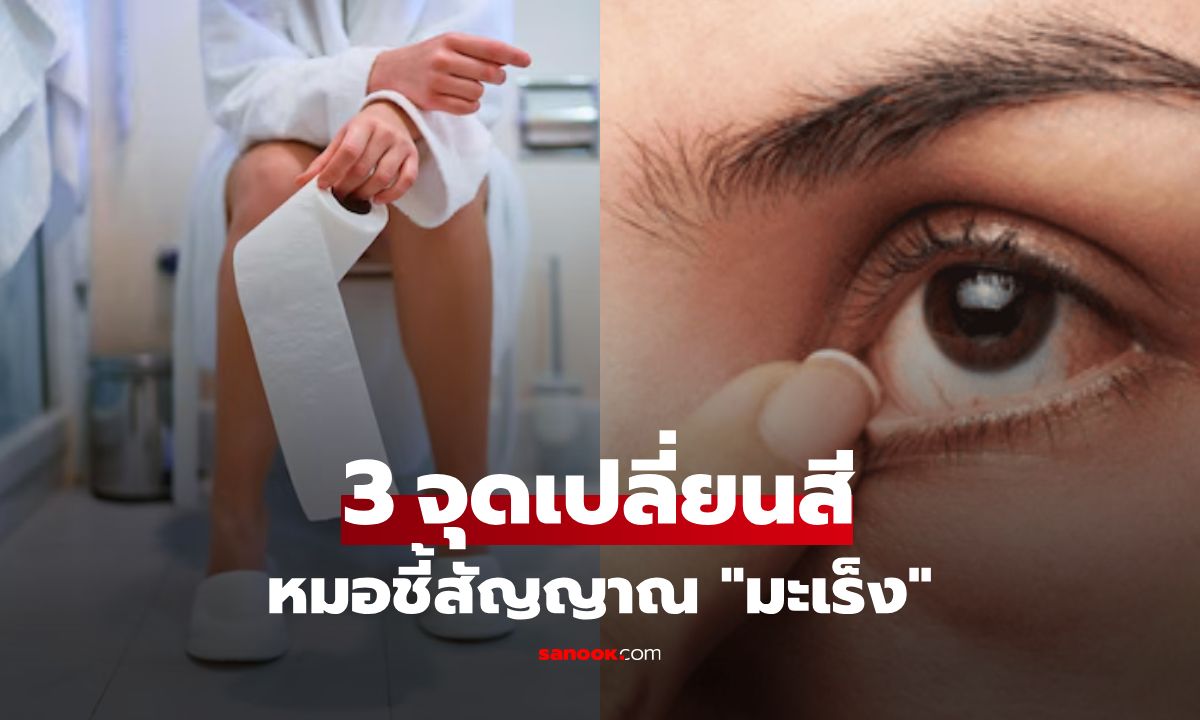 3 ส่วนนี้ในร่างกาย "เปลี่ยนสี" สัญญาณมะเร็งบุก แพทย์ย้ำต้องเช็กทุกวัน!