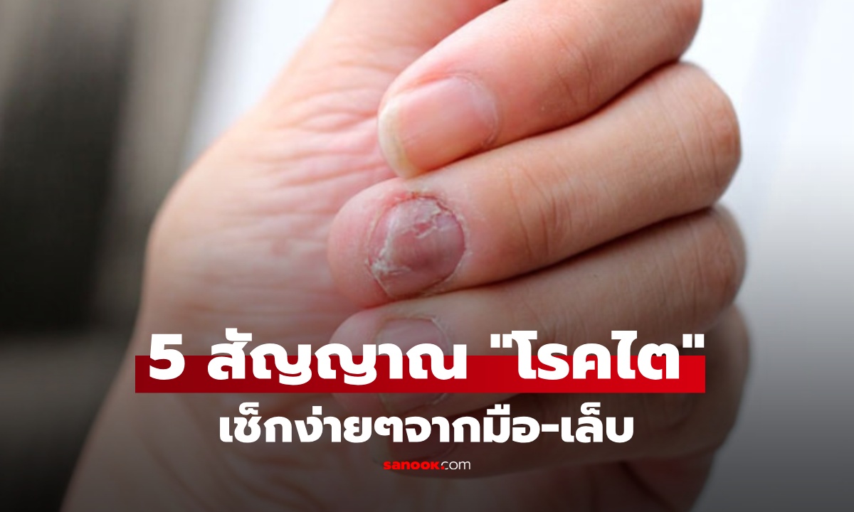 อย่ามองข้าม! 5 อาการบนมือและเล็บ สัญญาณ "โรคไต" ที่คนมักไม่รู้