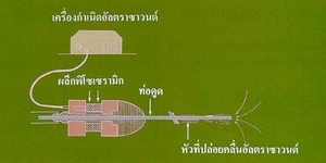 เครื่องสลายนิ่ว