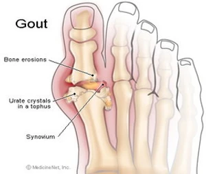 โรคเกาต์  Gout