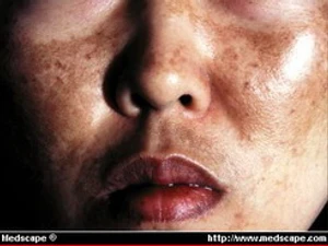 ฝ้า Melasma / Chloasma