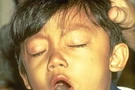 โรคไอกรน (Pertussis)