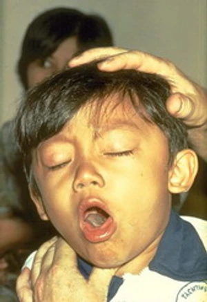 โรคไอกรน (Pertussis)