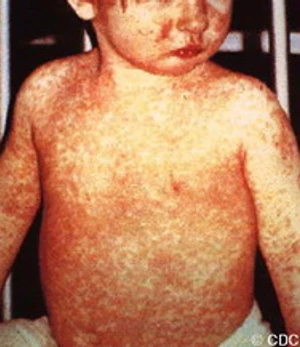 โรคหัด  (Measles)