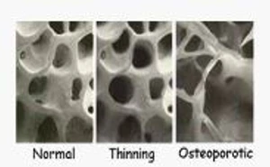 โรคกระดูกพรุน (Osteoporosis)