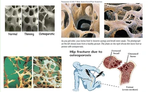 โรคกระดูกพรุน  (Osteoporosis)