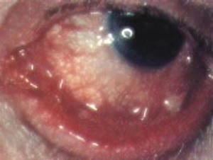 โรคตาแดงจากเชื้อไวรัส (Hemorrhagic Conjunctivitis)