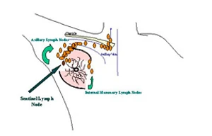 การผ่าตัดมะเร็งเต้านมแบบ Sentinel node โดยไม่ต้องเลาะต่อมน้ำเหลืองรักแร้