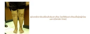 ข้อเข่าเทียมเพื่อผู้หญิงโดยเฉพาะ (Gender Knee)