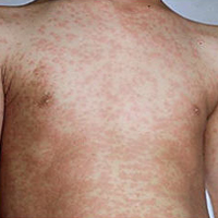 ไข้ออกผื่น หรือ โรคหัด (Measles)