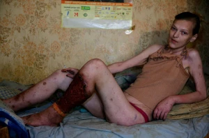 Krokodil ยาเสพติดที่อันตรายที่สุดในโลก