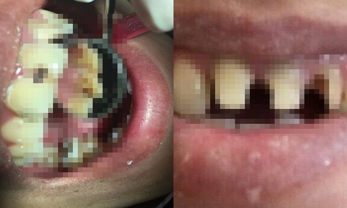 ฟันหน้าผุ 10 ปี เพิ่งรักษา อุทาหรณ์ของคนกลัวหมอฟัน