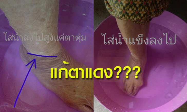 แบบนี้ก็ได้เหรอ? “ตาแดง” แช่เท้าในน้ำเย็นแล้วจะหาย?