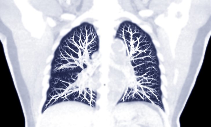 Pulmonary tuberculosis, symptoms and interactions of pulmonary tuberculosis Ready to treat AHR0cHM6Ly9zLmlzYW5vb2suY29tL2hlLzAvdWQvMC80NjkvbHVuZy5qcGc=