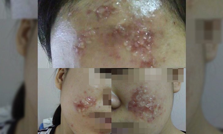 ระวัง! หน้าไหม้ เพราะ ที ทรี ออยล์ น้ำมันหอมระเหย