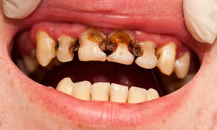 สงสัยไหม? ไม่แปรงฟัน 1 สัปดาห์ จะเกิดอะไรขึ้น?