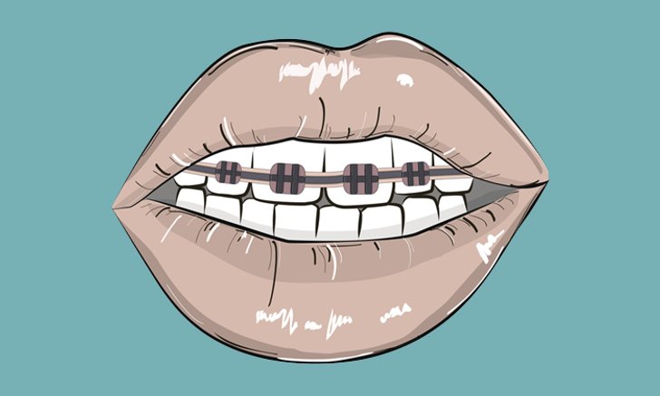 "จัดฟันแฟชั่น" อันตรายถึงชีวิต สวยหลอก แต่เจ็บจริง