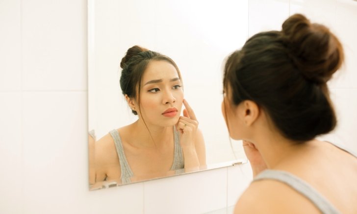 ทำอย่างไร? ไม่ให้เกิด "สิว" ซ้ำซาก