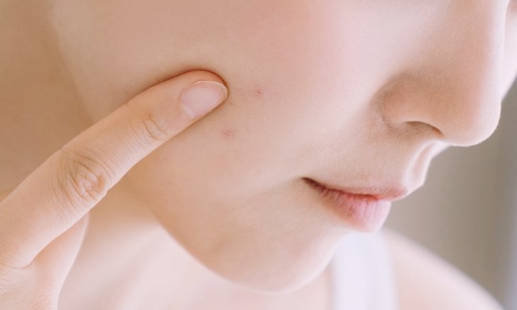 มารู้จักยารักษาสิว “isotretinoin” ให้มากขึ้น