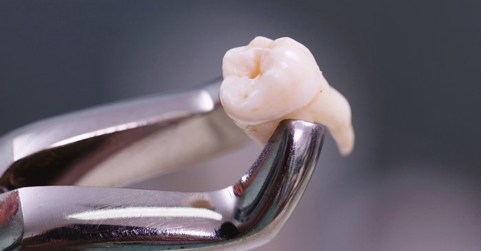สังเกต "ฟันตาย" อันตรายภายในปากที่คุณอาจเป็นโดยไม่รู้ตัว