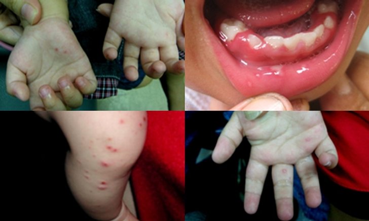อาการของโรคมือเท้าปาก วิธีป้องกันและดูแลเด็กที่เป็นโรคมือเท้าปาก