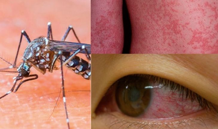 พบในไทย! ไวรัส Zika ติดต่อทางยุง อาการคล้ายไข้เลือดออก