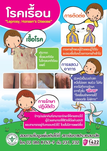 เปิดสถิติบุรีรัมย์ป่วย "โรคเรื้อน" อันดับ 4 ของประเทศ สาธารณสุขเอาจริง!!! เร่งป้องกันเชิงรุก