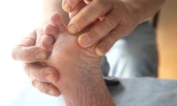 5 วิธีดูแลเท้าผู้ป่วยเบาหวาน เลี่ยงการถูก “ตัดเท้า”