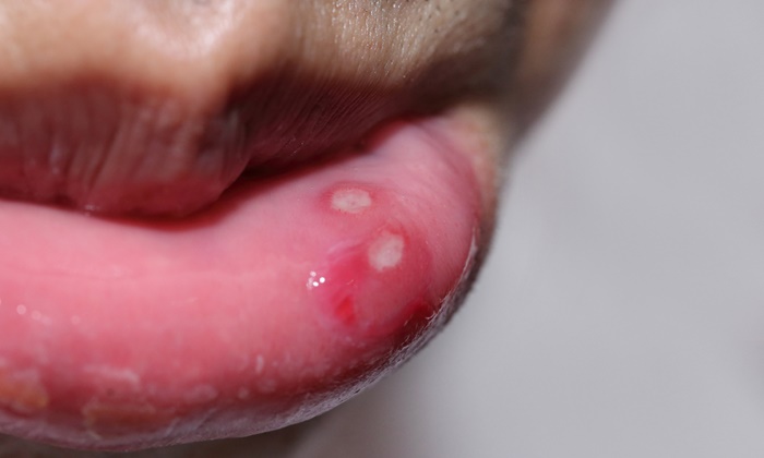 mouth-ulcer-2
