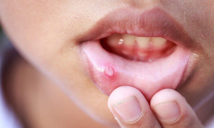 แผลในปากอาจไม่ใช่ร้อนใน แต่เป็น “มะเร็งช่องปาก”