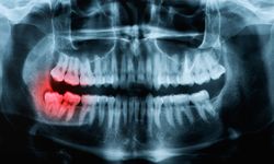 ฟันคุดคืออะไร? ทำไมต้องผ่าฟันคุด? ไม่ผ่าได้ไหม?