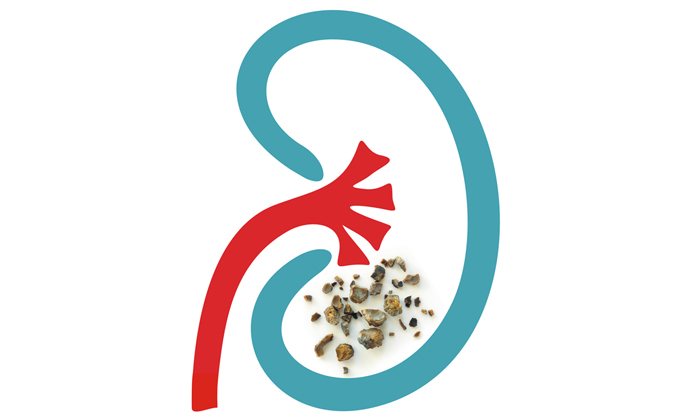 kidney-stones