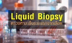 Liquid Biopsy เทคโนโลยีตรวจหามะเร็งระยะแรก เพียงเจาะเลือด