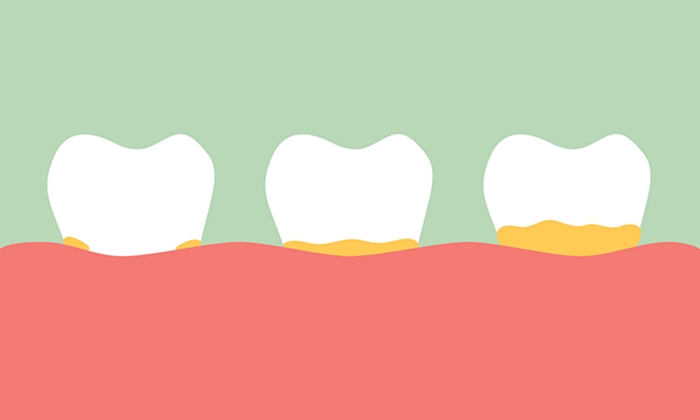 5 สัญญาณอันตรายภายในช่องปาก สาเหตุฟันผุ-เหงือกบวม