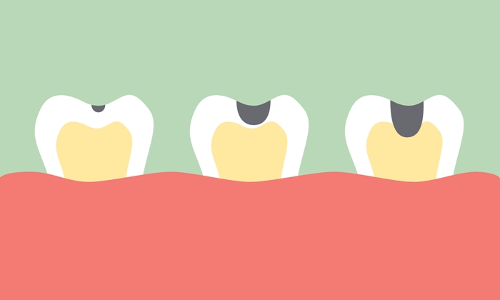 10 พฤติกรรมเสี่ยง “เสียวฟัน-ฟันผุ”