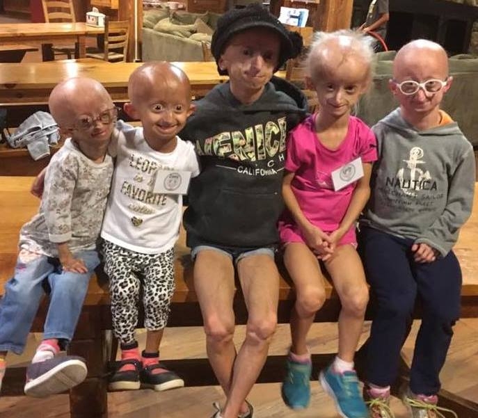 progeria-2